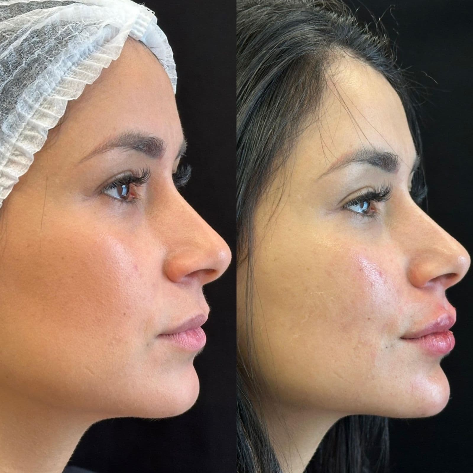 Antes y Después — Perfil — Después