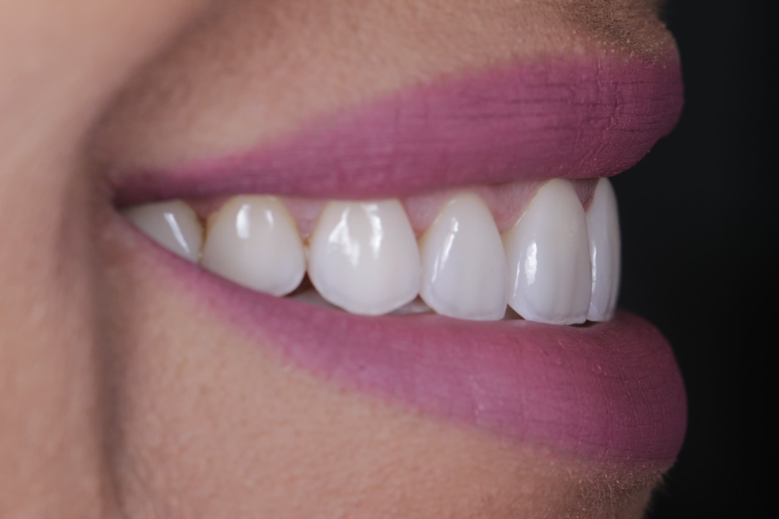 Carillas — Sonrisa Transformada — After