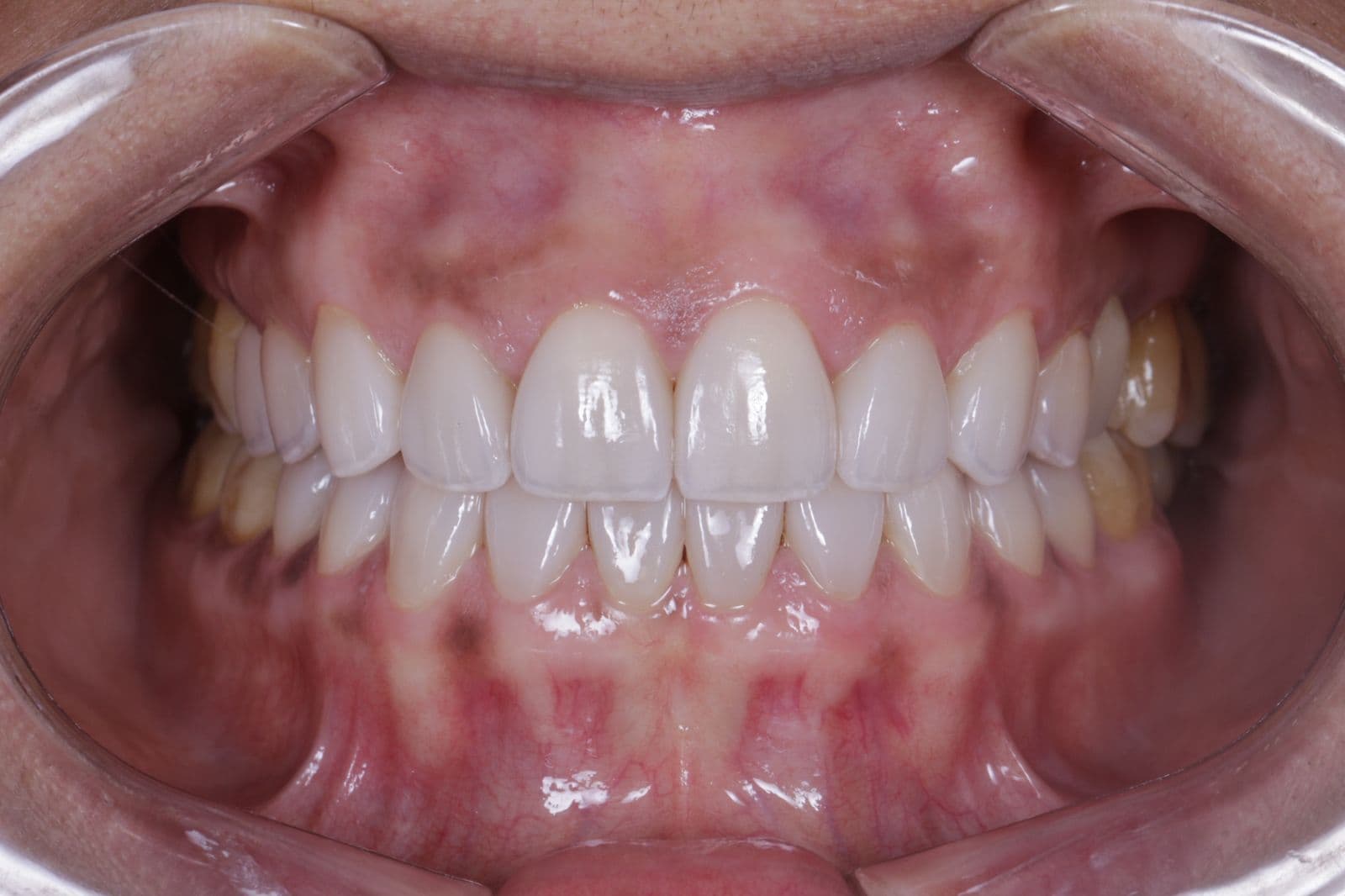 Carillas Intraoral — Después