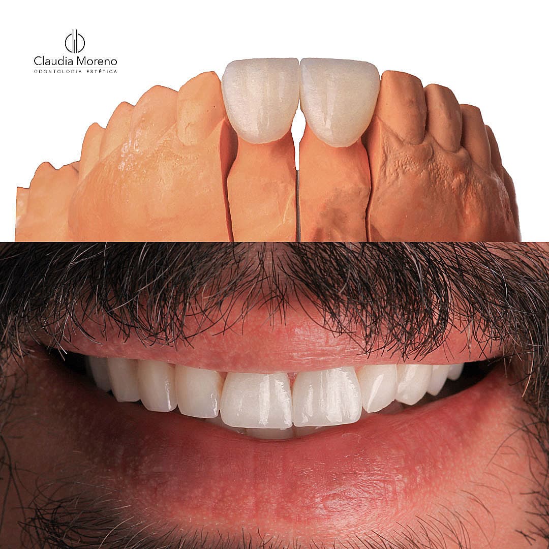 Carillas — Modelo y Resultado — Después