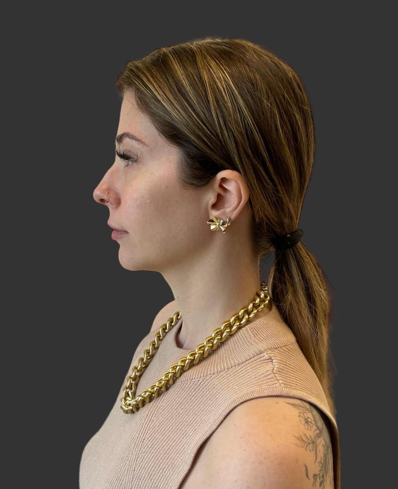 Caso de Perfilado mandibular — Dra. Claudia Moreno