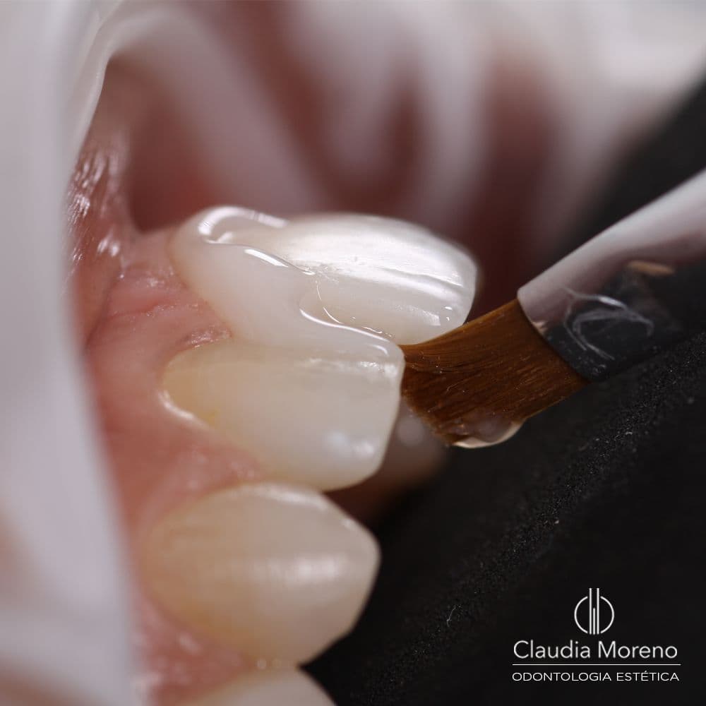 Procedimiento Carillas — Después