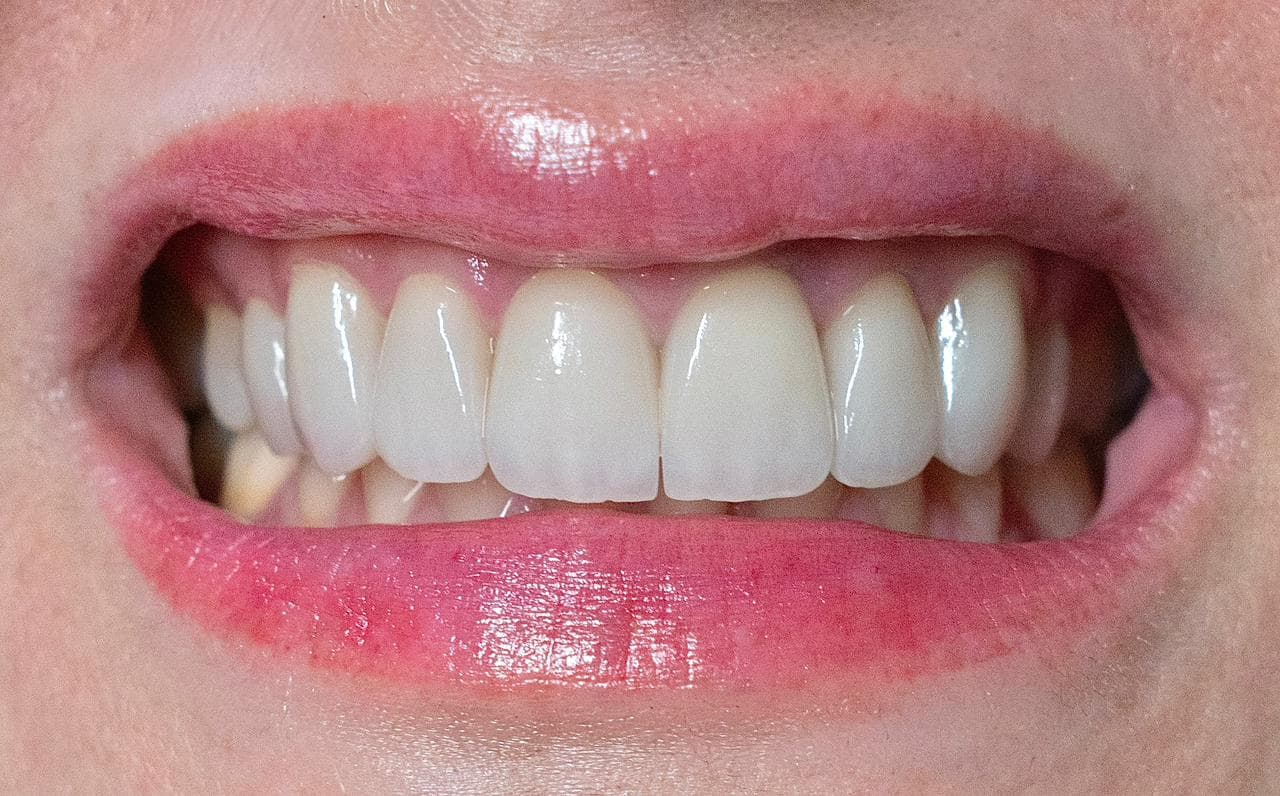 Carillas de Porcelana — After